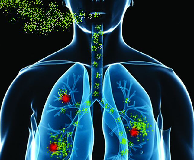 Lung exposure to radon